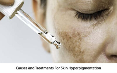 Causes and Treatments for Skin Hyperpigmentation