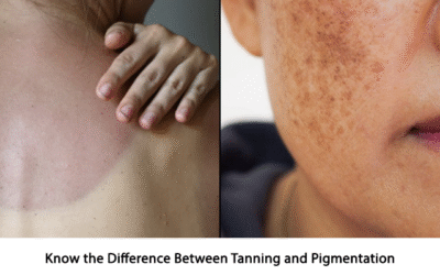 Know the Difference Between Tanning and Pigmentation