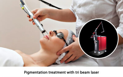 Pigmentation treatment with tri beam laser