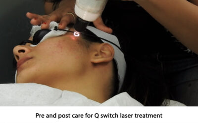 Pre and post care for Q-switch laser treatment